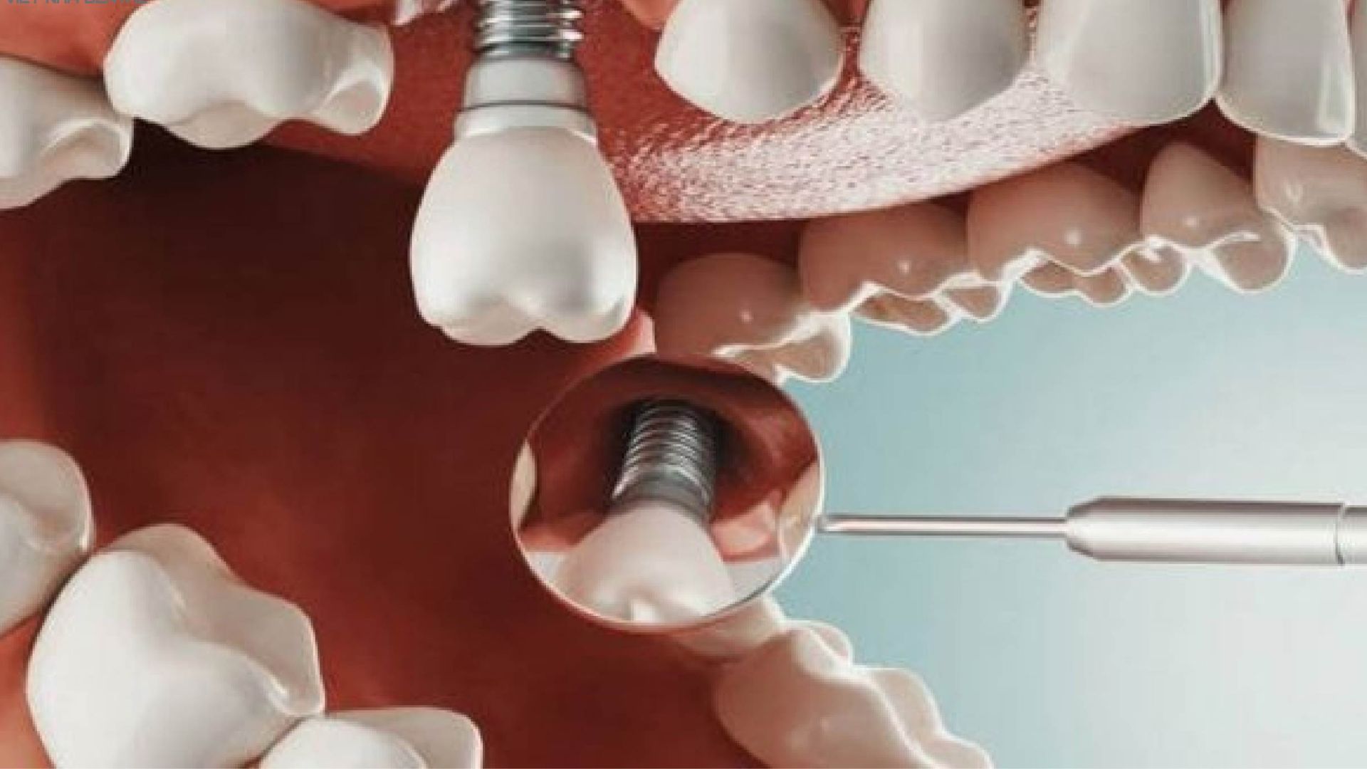  biến chứng trồng răng Implant 