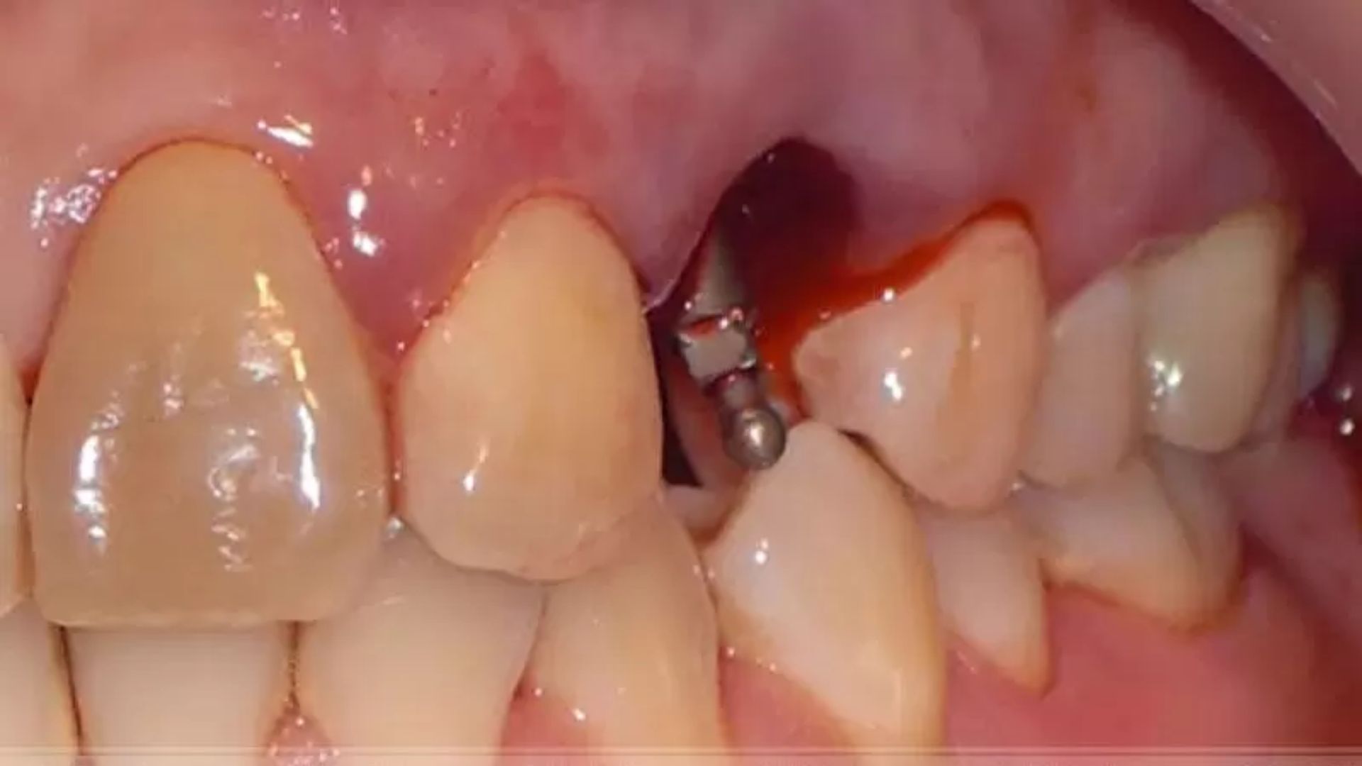  biến chứng trồng răng Implant 