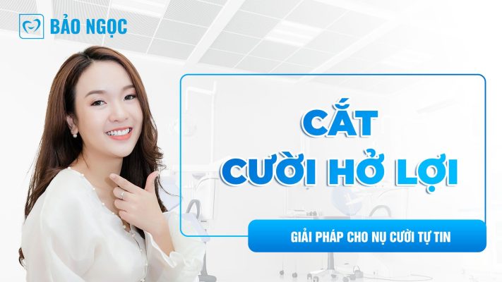 Cắt cười hở lợi: Giải pháp hiệu quả cho nụ cười tự tin dành cho bạn 