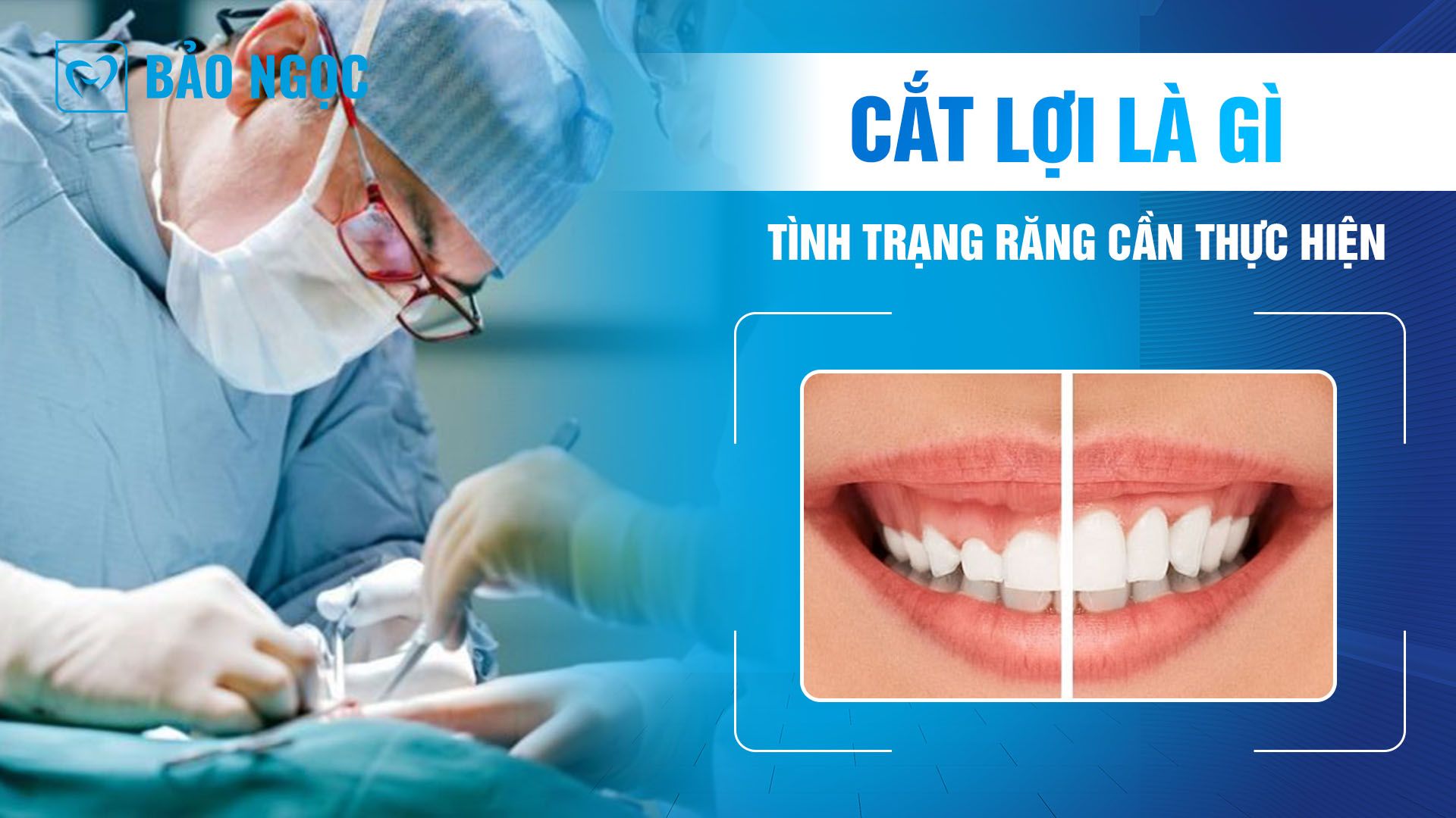 Cắt lợi là gì Có nên cắt nướu không và tình trạng răng cần thực hiện