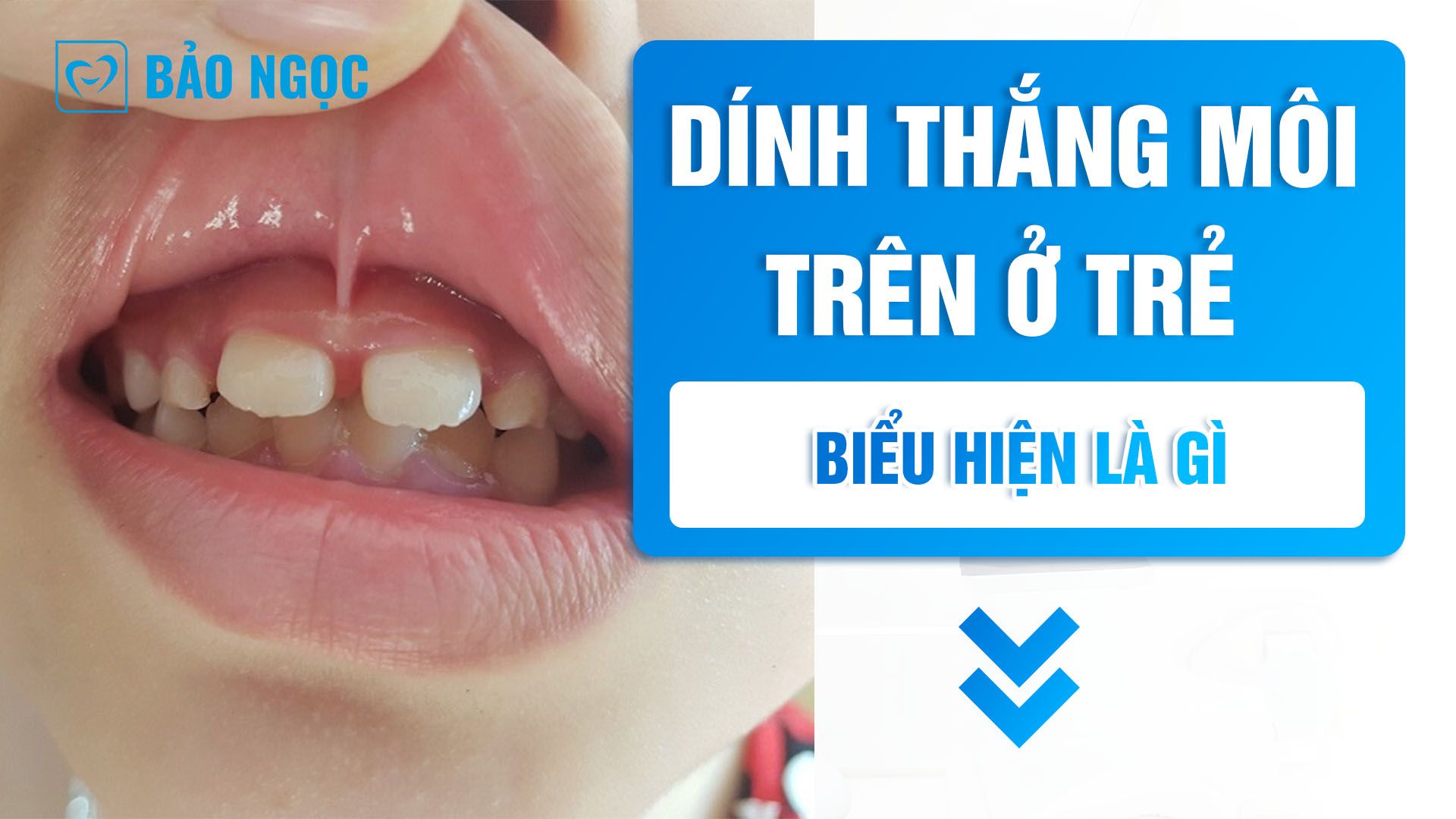 Dính thắng môi trên ở trẻ với biểu hiện là gì?