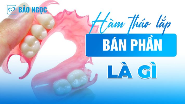 Hàm tháo lắp bán phần là gì? Lợi ích và cách chăm sóc hiệu quả 