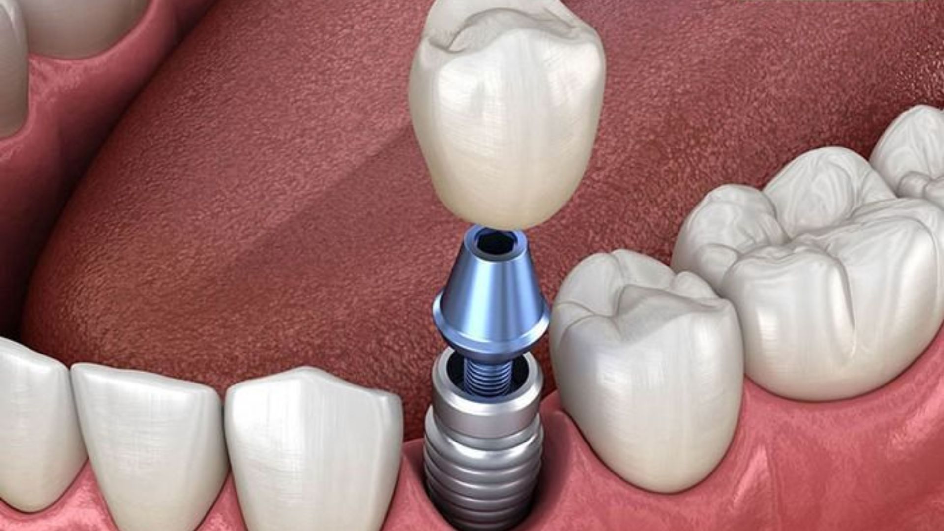 Trồng răng Implant bắt vít và điều bạn cần phải biết khi thực hiện