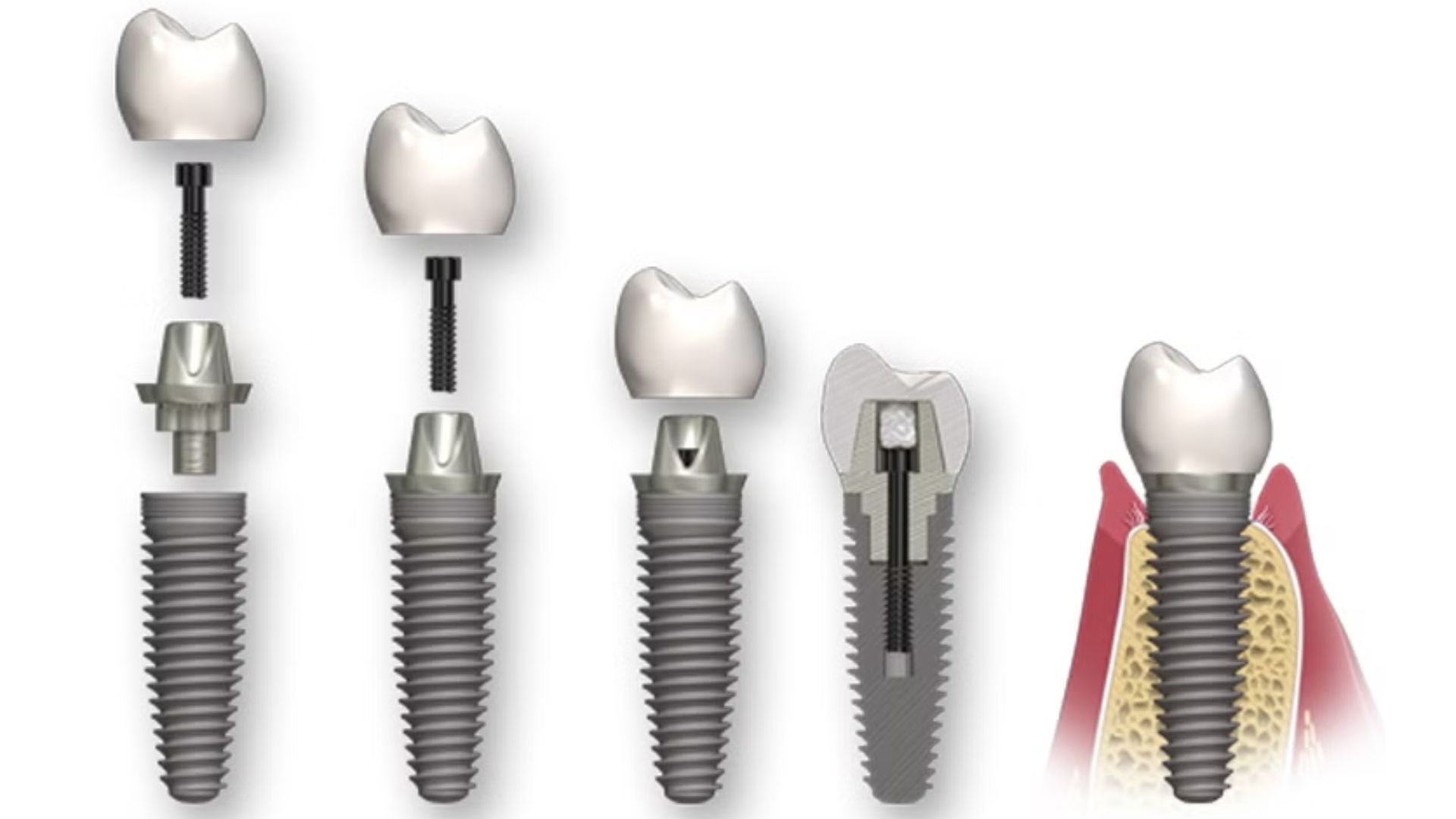 Trồng răng Implant bắt vít và điều bạn cần phải biết khi thực hiện