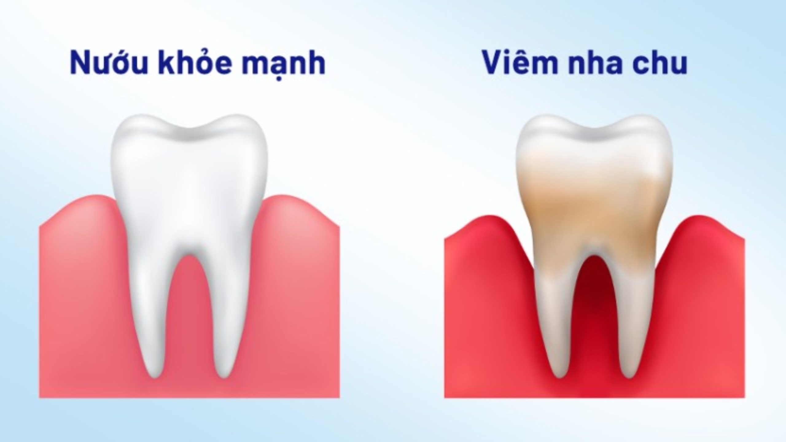 Viêm nha chu chân răng 