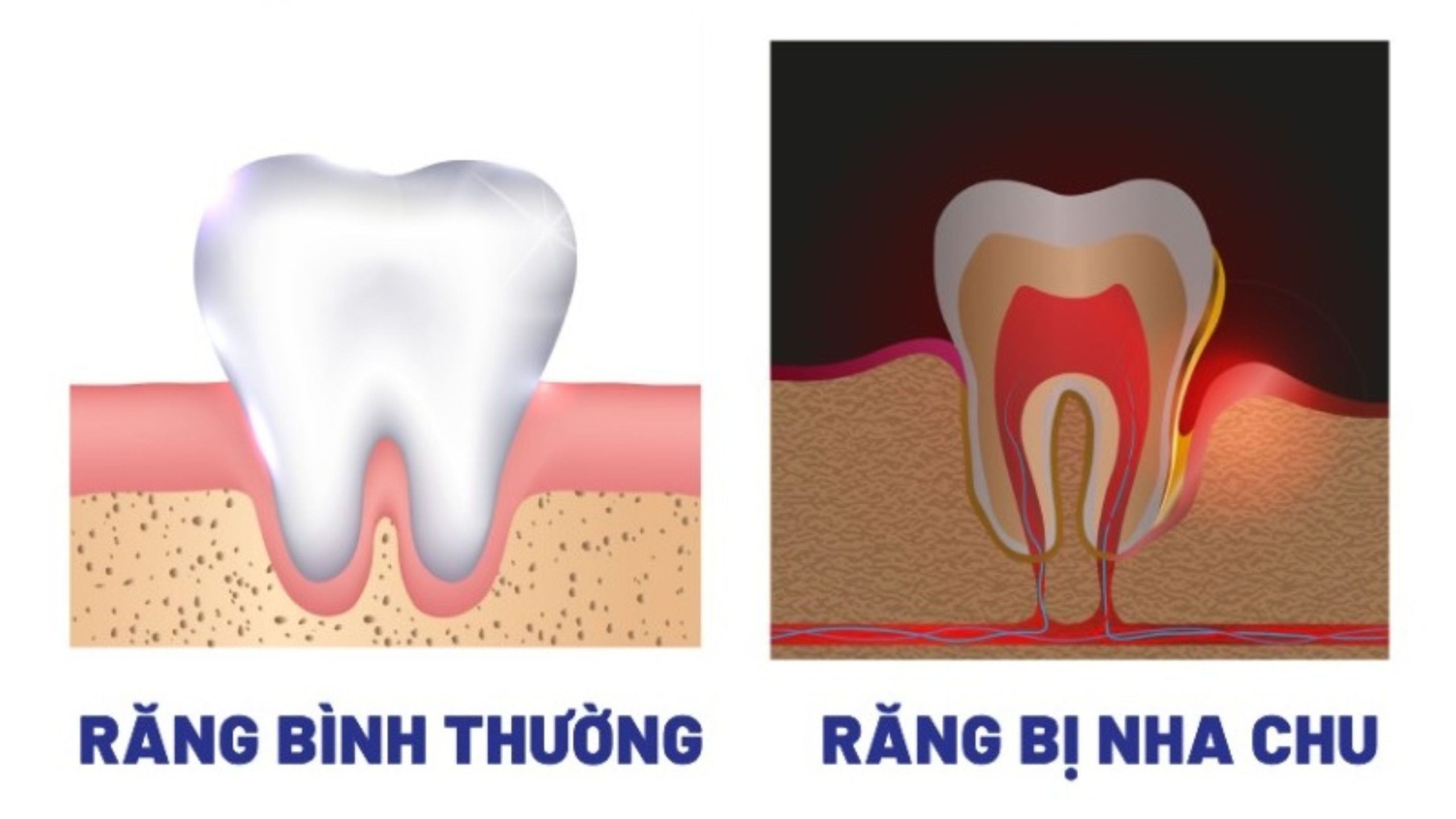 Viêm nướu và bệnh nha chu