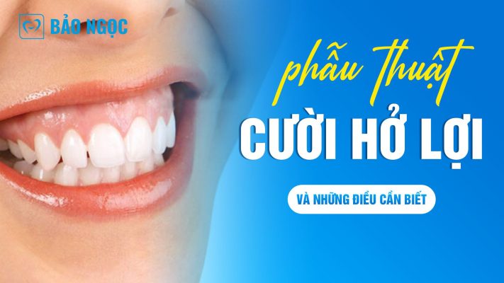 Những điều về phẫu thuật cười hở lợi trước khi thực hiện bạn chưa biết