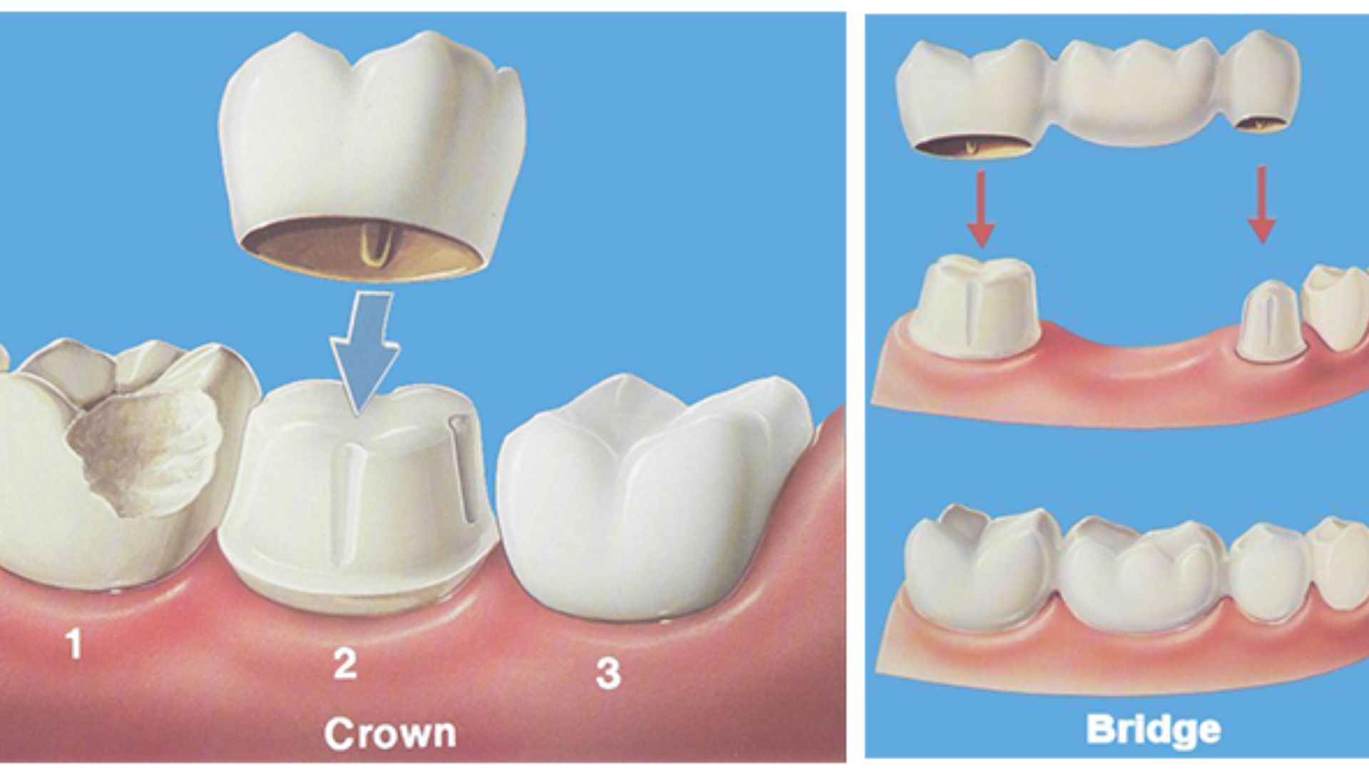 Phục hình răng là gì Có những phương pháp nào được ứng dụng phổ biến