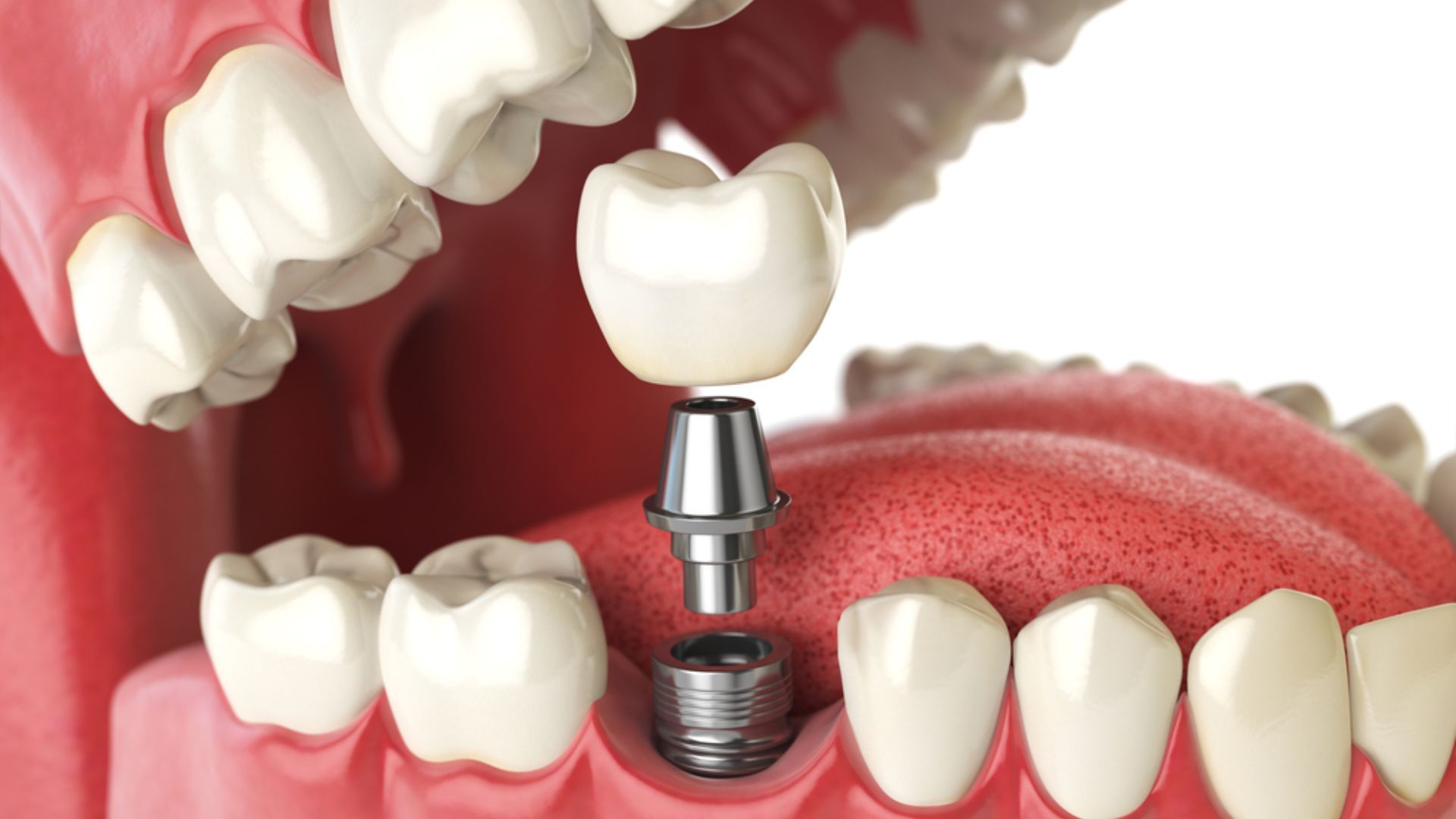 Phục hình răng là gì Có những phương pháp nào được ứng dụng phổ biến