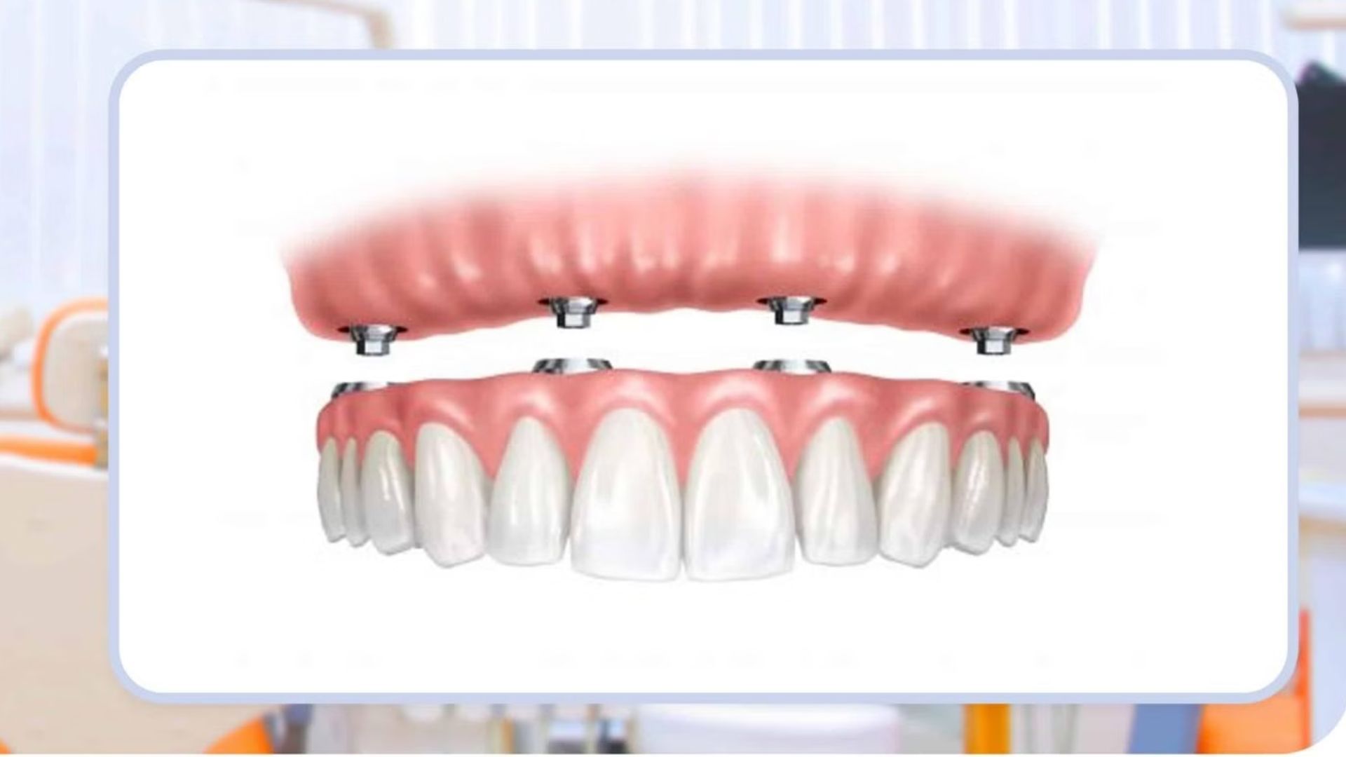 Răng tạm trên Implant 