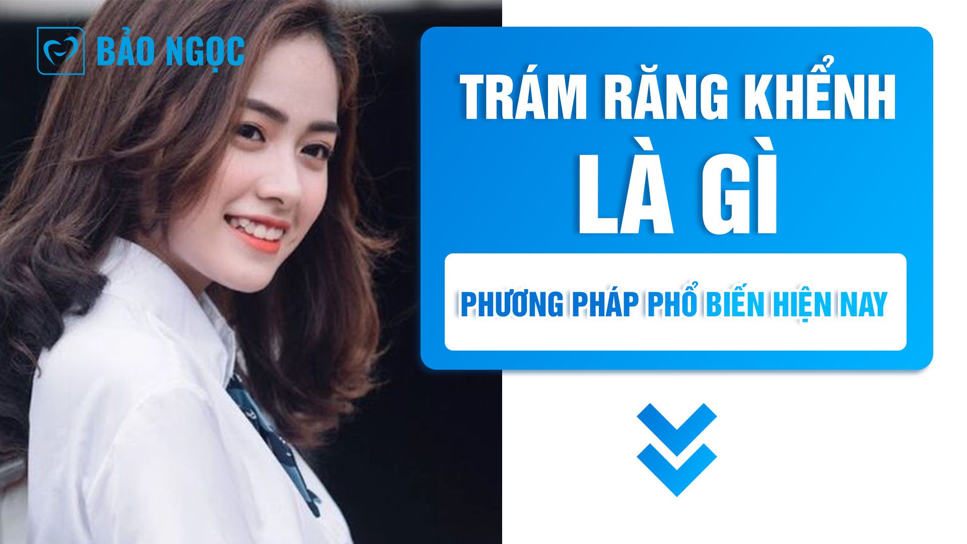 Trám răng khểnh