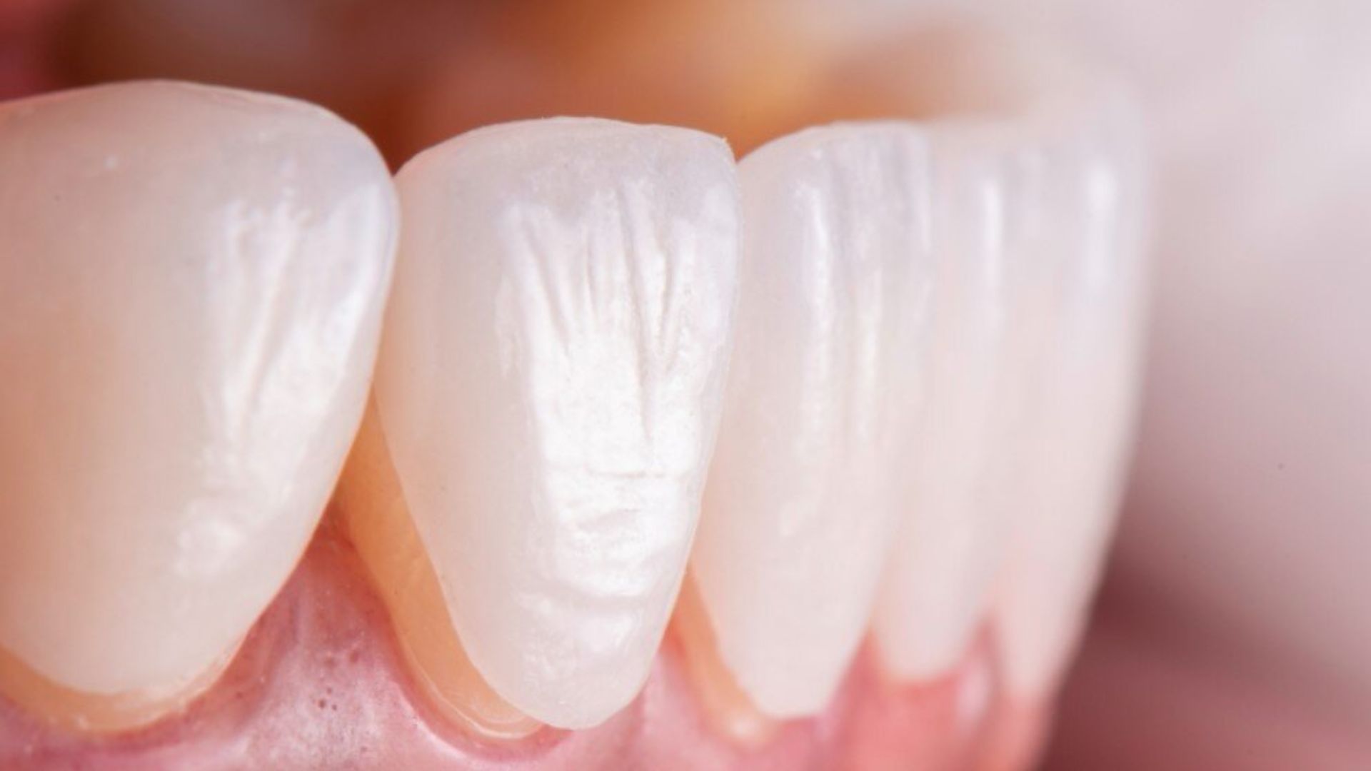 Dán sứ veneer không mài răng