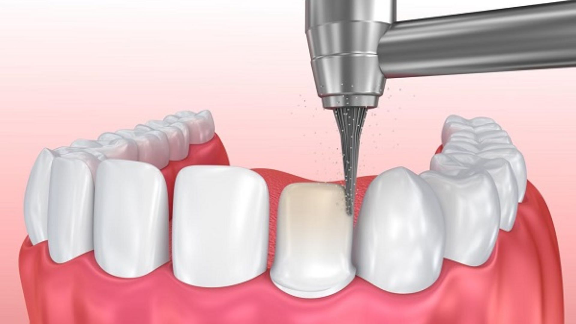 mài cùi răng thẩm mỹ 