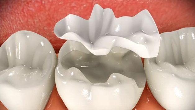 Hàn răng người lớn bằng Composite