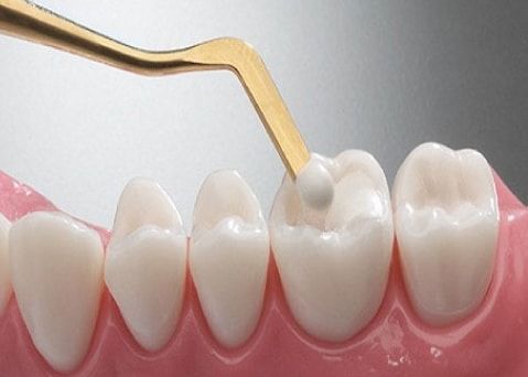 Hàn răng trẻ em bằng Composite