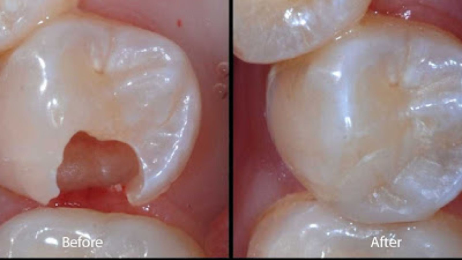 Trám răng composite là gì? Giải pháp phục hồi nhanh chóng mà bạn chưa biết?