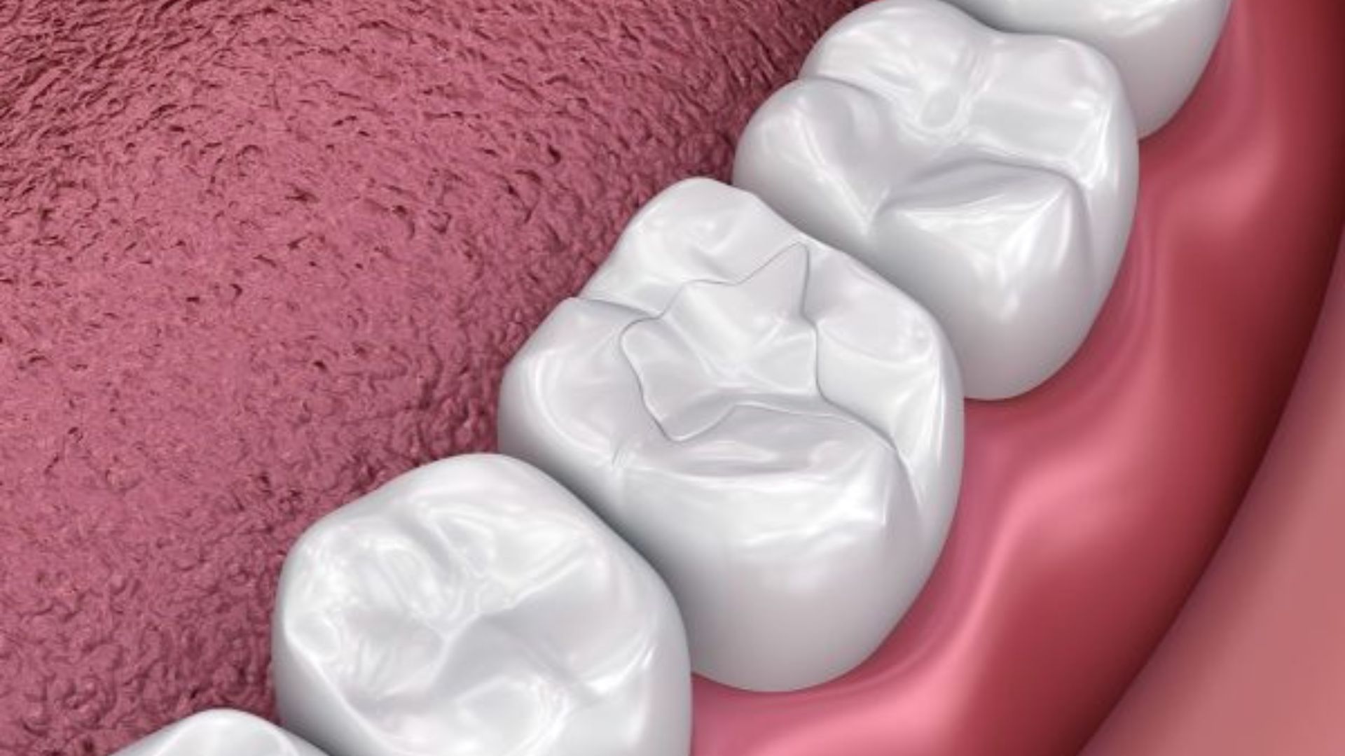 Trám răng composite là gì? Giải pháp phục hồi nhanh chóng mà bạn chưa biết?