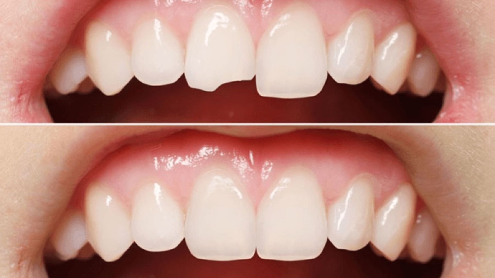 Trám răng composite là gì? Giải pháp phục hồi nhanh chóng mà bạn chưa biết?