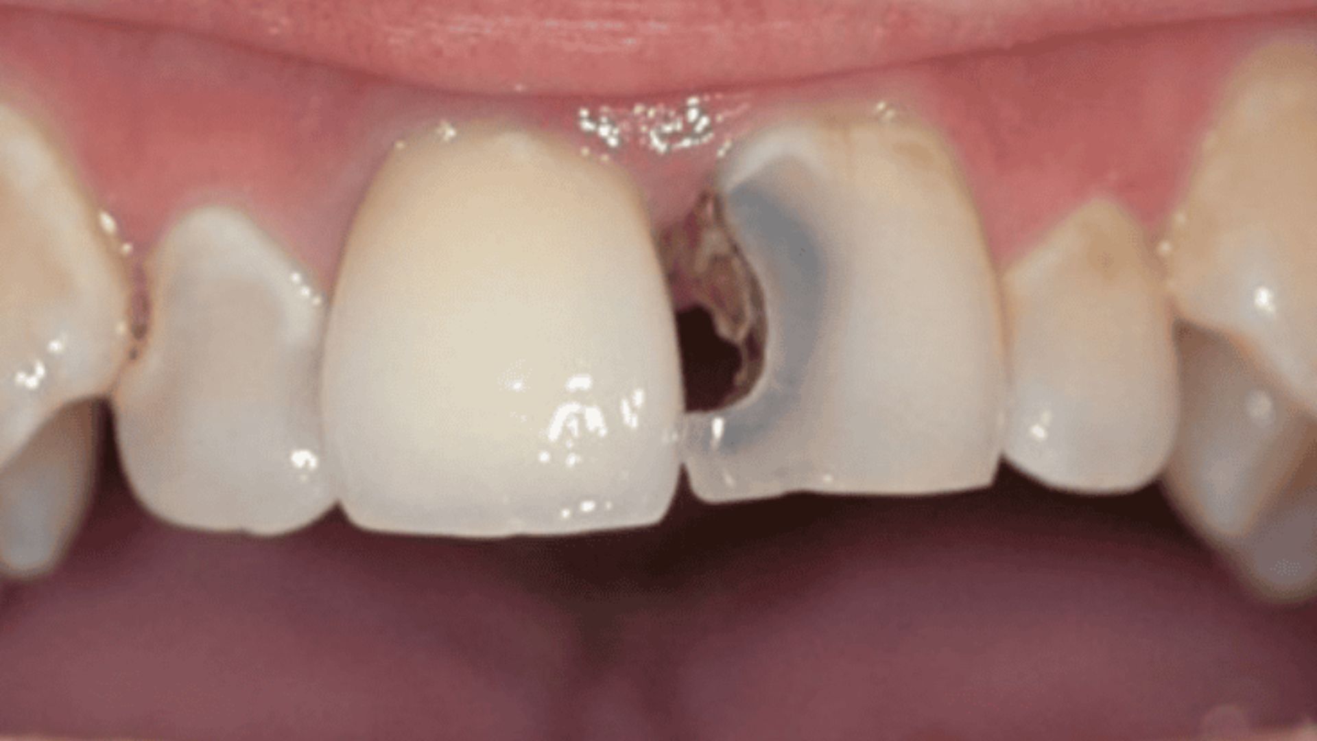 Trám răng cửa thẩm mỹ 