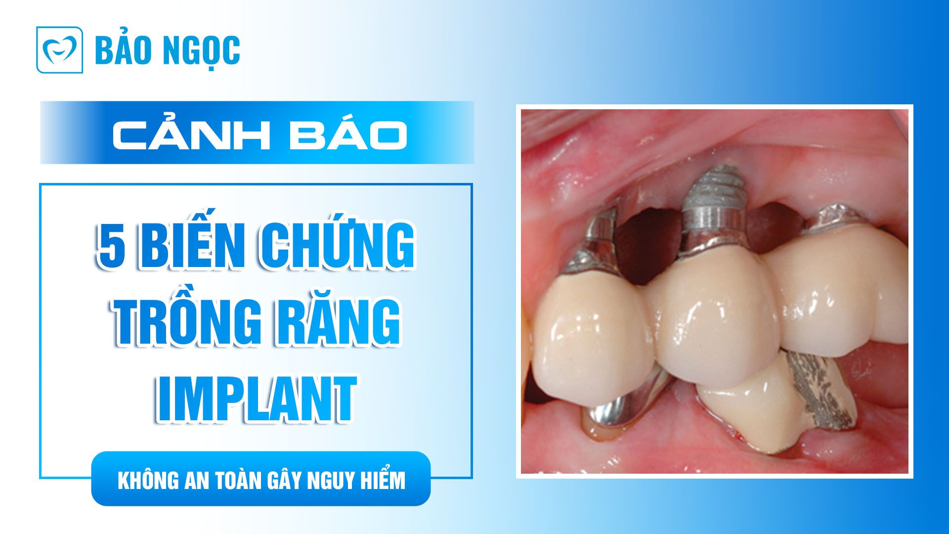 Cảnh báo 5 biến chứng trồng răng Implant không an toàn gây nguy hiểm