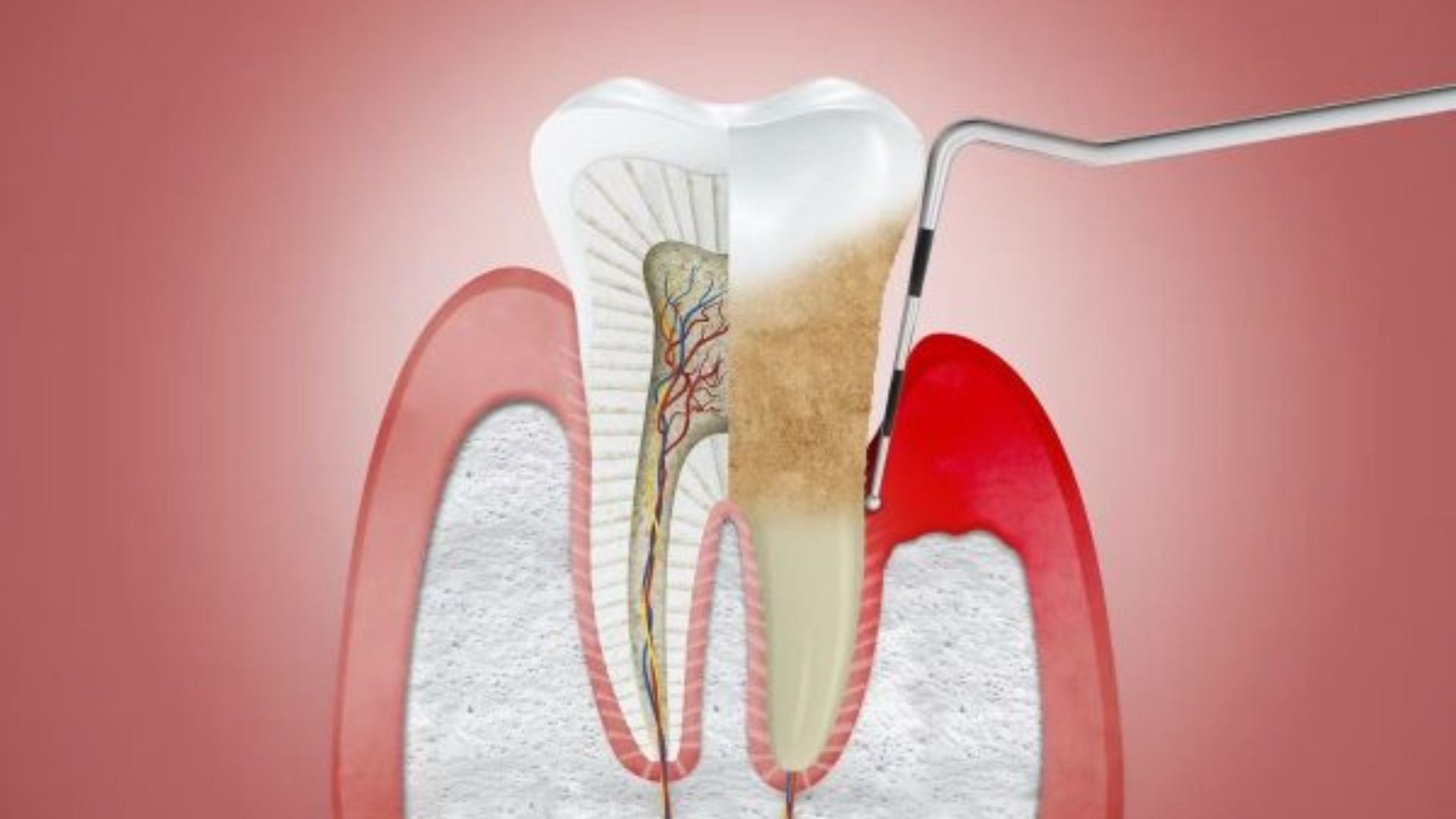 Cuống răng là gì? Nguyên nhân gây bệnh và cách chữa viêm cuống răng