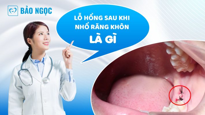 Lỗ hổng sau khi nhổ răng khôn là gì? Nguyên nhân và cách khắc phục
