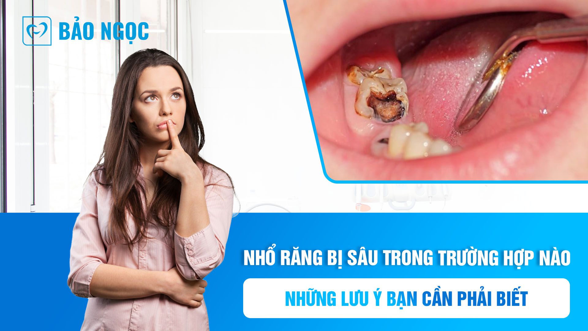 Nhổ răng bị sâu trong trường hợp nào? Những lưu ý bạn cần phải biết.