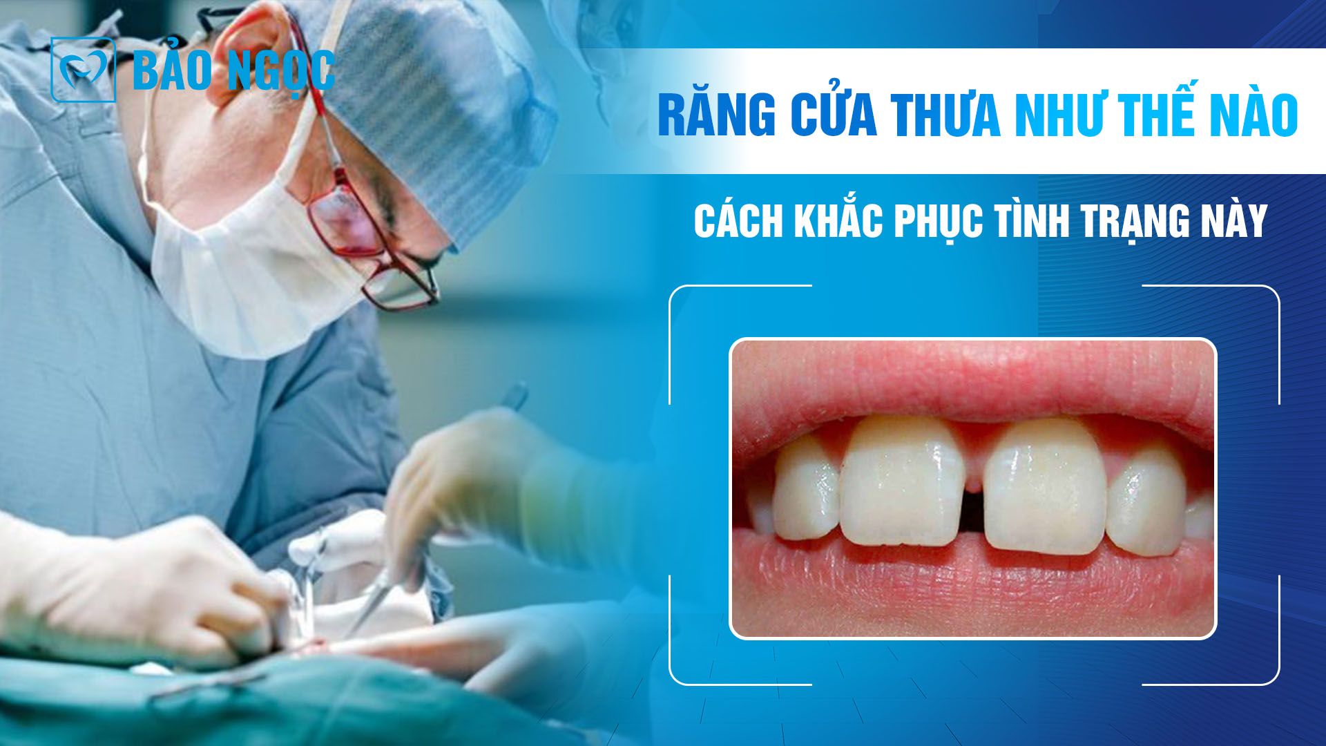 Răng cửa thưa như thế nào? Cách khắc phục tình trạng này tốt nhất
