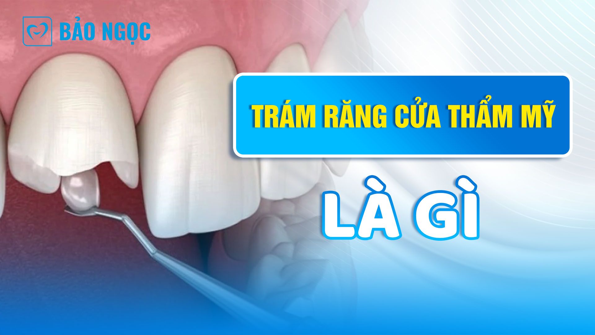 Trám răng cửa thẩm mỹ là gì? Khi nào nên thực hiện phương pháp này