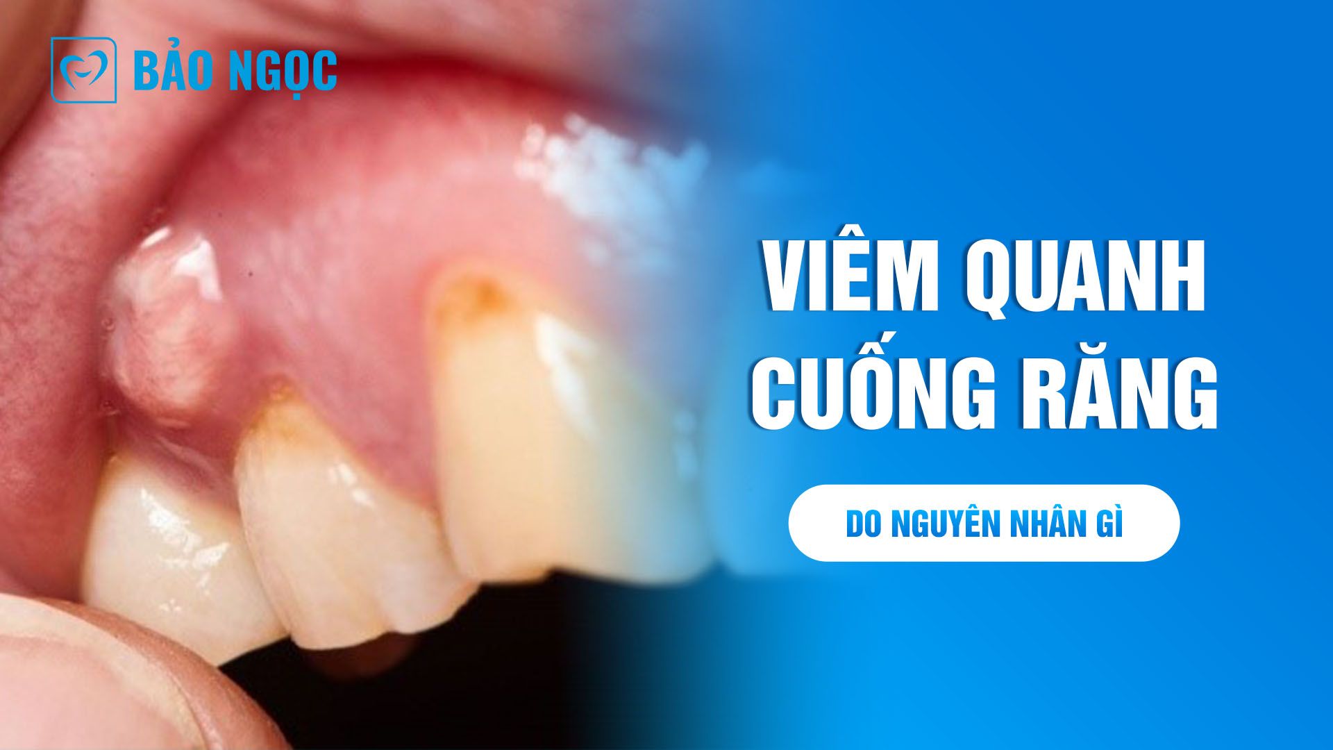 Viêm quanh cuống răng do nguyên nhân gì? Triệu chứng và biến chứng