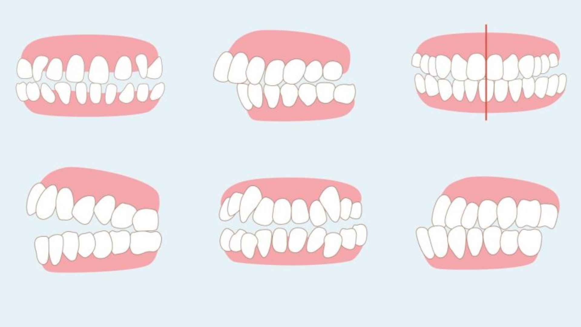 Lệch khớp cắn là gì Nó gây ảnh hưởng tới chức năng ăn nhai như thế nào