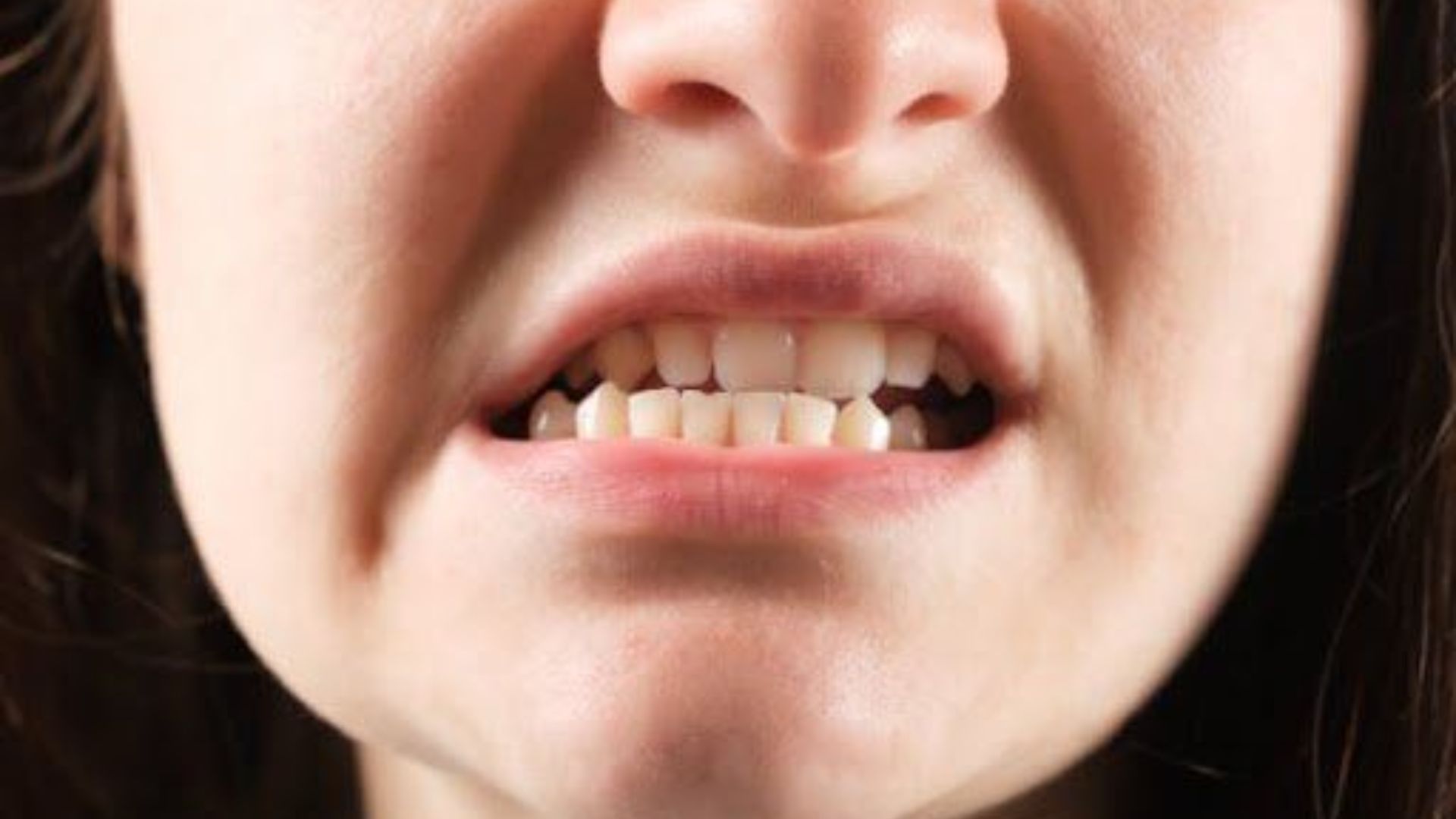 Lệch khớp cắn là gì Nó gây ảnh hưởng tới chức năng ăn nhai như thế nào