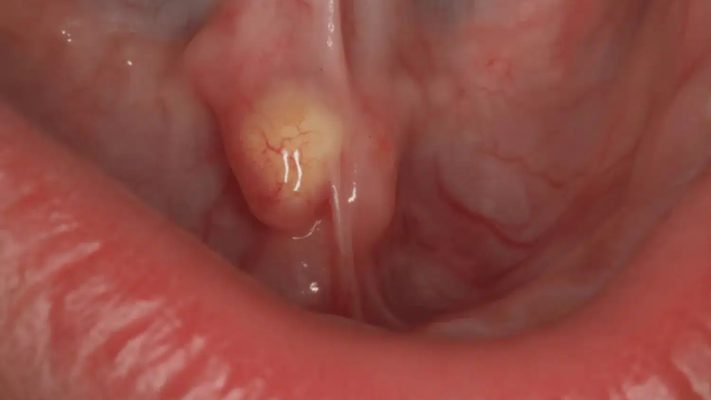 Sỏi tuyến nước bọt dưới lưỡi dấu hiệu như thế nào Nguyên nhân là gì