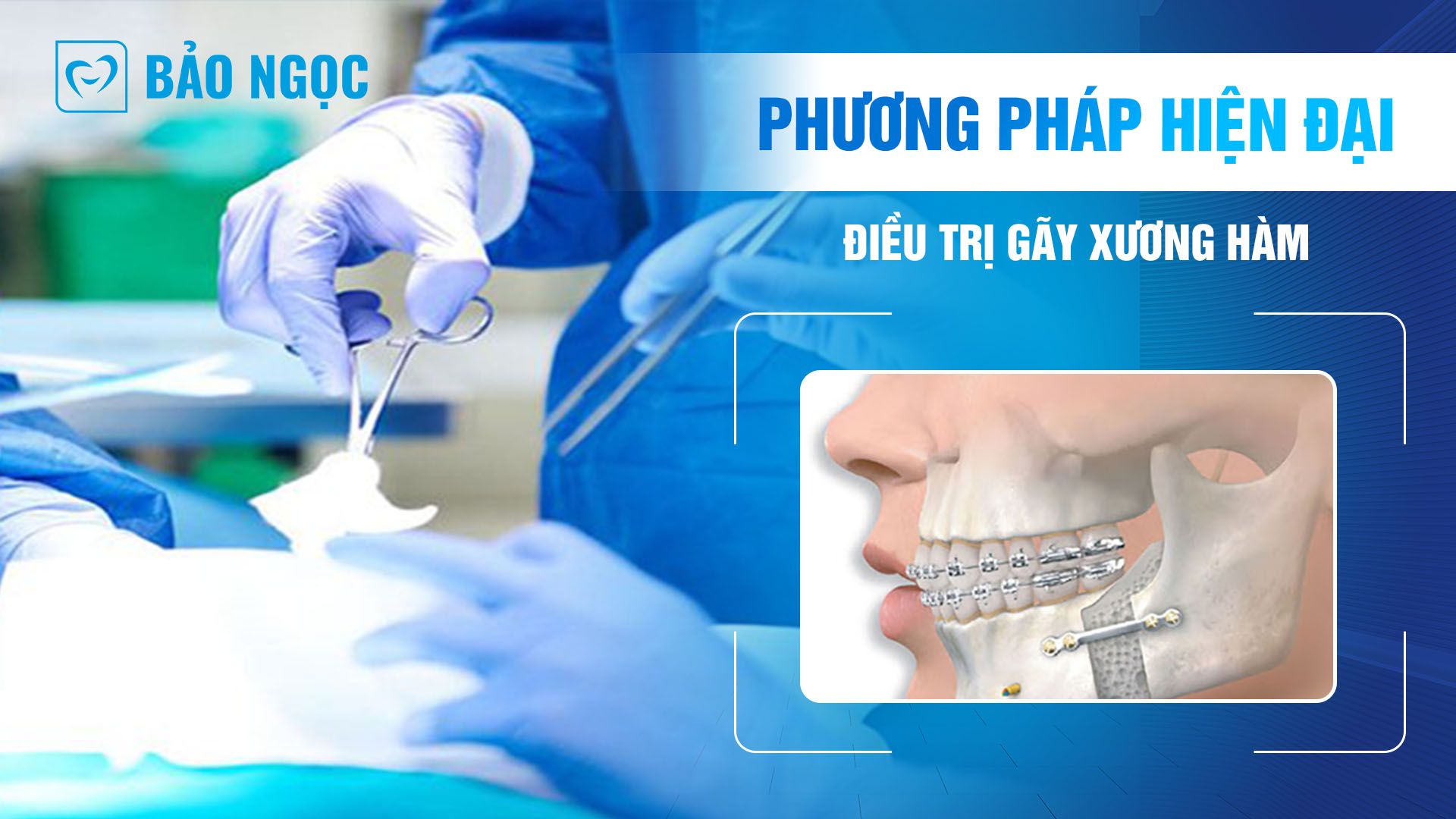 Nẹp vít gãy xương hàm: Phương pháp hiện đại điều trị gãy xương hàm